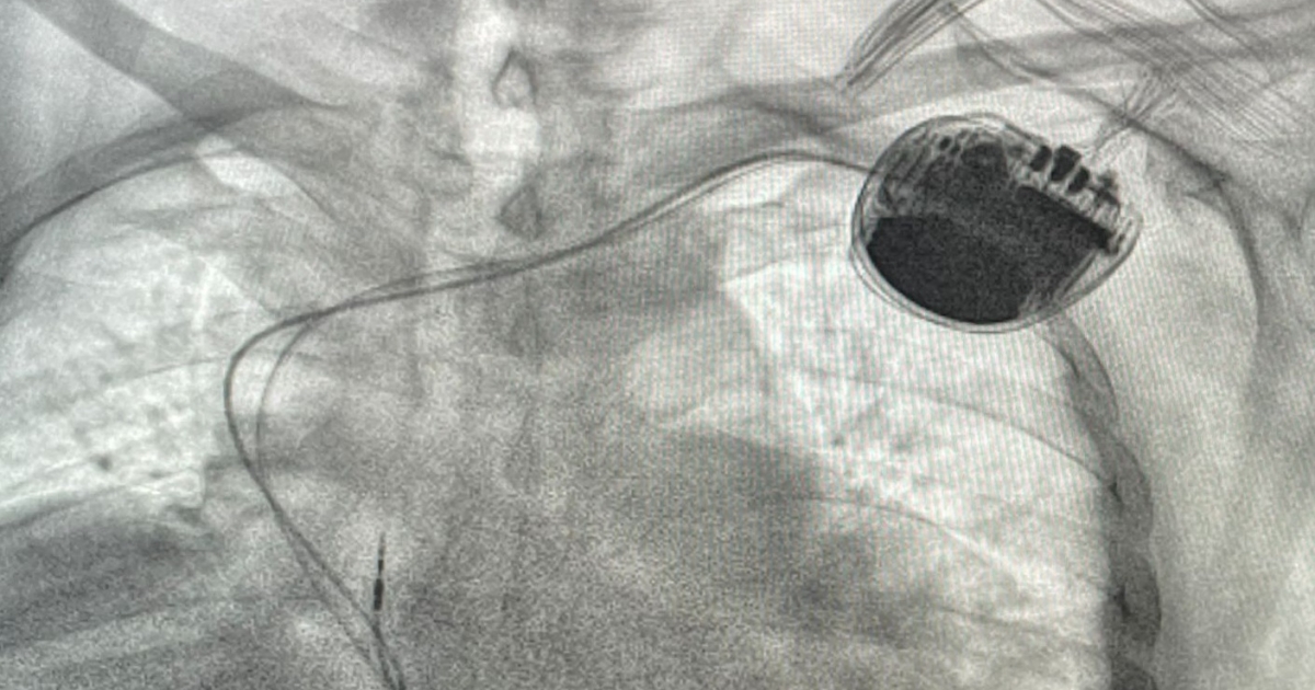 Első alkalommal ültettek be szívbe defibrillátort a csíkszeredai kórházban