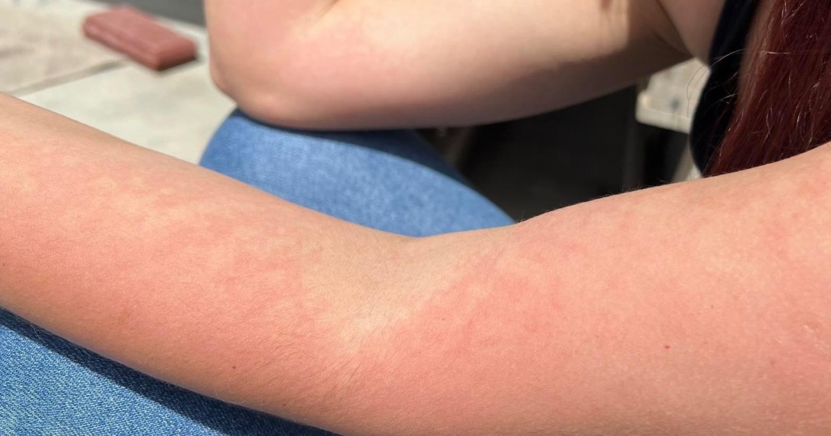 Terjed a lepkehimlő