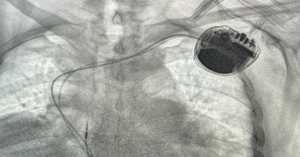 Első alkalommal ültettek be szívbe defibrillátort a csíkszeredai kórházban