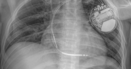 Hősies küzdelem zajlott egy 22 éves fiatal életéért a csíkszeredai kórházban